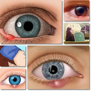 Styes: Causes, Symptoms and Treatment – NatureWord