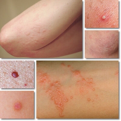 Health Page 2 NatureWord   Red Bumps On Arm 400x400 